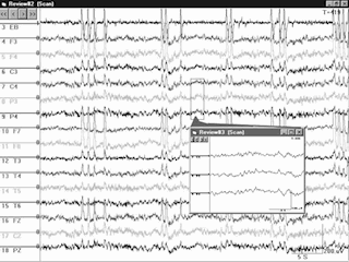 EEG